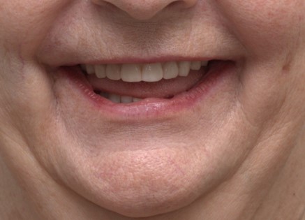 Harmony Oral Facial Surgery | Botox reg , PRF and Fillers