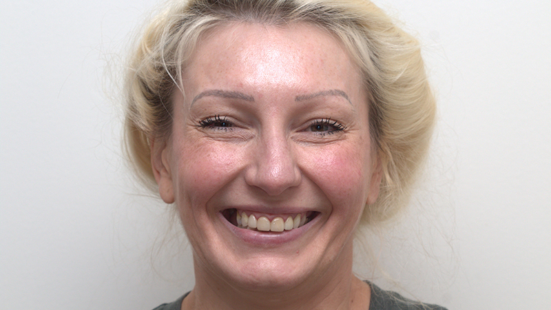Harmony Oral   Facial Surgery | Fillers, Emergency Treatment and Zygomatic Implants